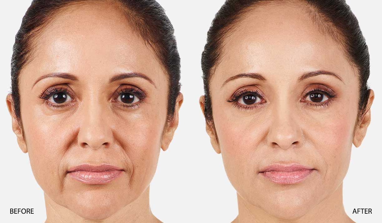 Nasolabial Folds – Surrey Medical Aesthetics