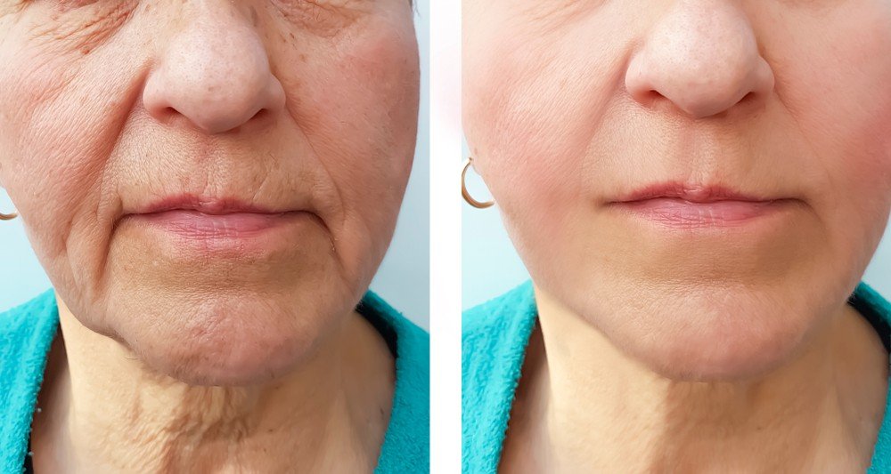 Marionette Lines – Surrey Medical Aesthetics